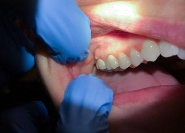 Best Emergency Treatment for Toothache in Olive Hill, KY